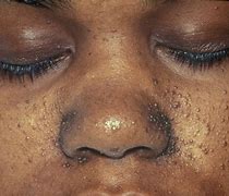 Image result for Treatment for Warts On Face