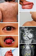 Image result for Kawasaki Disease in Adults