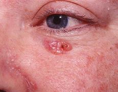 Image result for Irritated Basal Cell Papilloma
