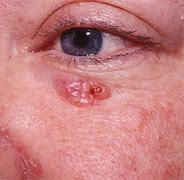 Image result for Basal Cell Carcinoma On Eyelid