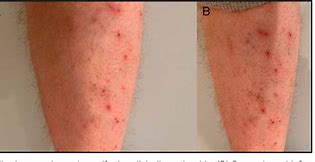 Image result for acrodermatitis_enteropathica