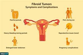 Image result for Uterus Fibrosis