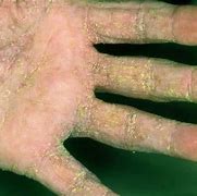 Image result for How Does Scabies Look Like