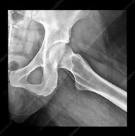 Image result for Normal Hip X-ray
