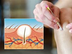 Image result for Ingrown Hair Stomach
