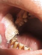 Image result for Filiform Wart in Mouth