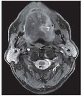 Image result for Head and Neck Cancer MRI