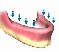Image result for Jaw Bone Loss