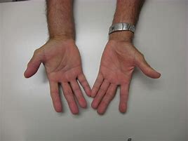 Image result for Synovitis Finger