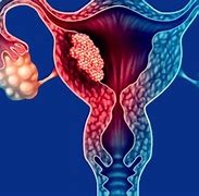 Image result for Endometrial