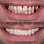 Image result for What Is the Difference Between Ceramic and Porcelain Teeth