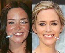 Image result for Emily Blunt Teeth Before and After