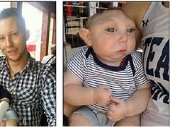 Image result for Baby Born with Anencephaly What Does the Baby Look Like