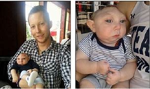 Image result for Longest Living Baby with Anencephaly