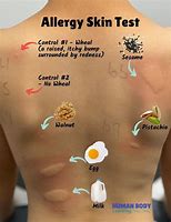 Image result for Baby First Food Allergy Rash