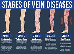 Image result for DVT Itchy Ankles