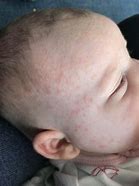 Image result for Baby Formula Allergy Rash