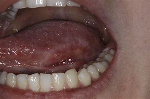 Image result for Pedunculated Oral Lesion