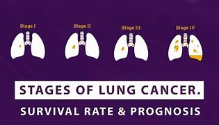 Image result for Tumor Size Chart for Lung Cancer