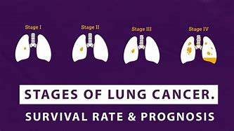 Image result for Lung Cancer Speed Run