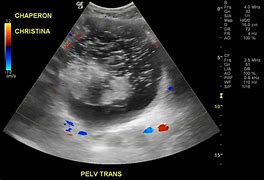 Image result for Dermoid Cyst On Ovary