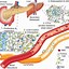 Image result for Bionic Pancreas