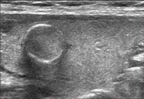 Image result for Thyroid Nodule with Calcification