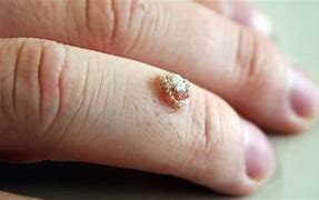 Image result for Wart vs Blister On Finger