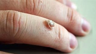 Image result for Clear Wart On Finger