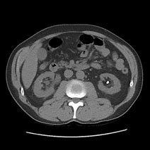 Image result for 2 Cm Kidney Stone