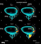 Image result for Bladder Cancer Stages