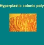 Image result for Hyperplastic Colon Polyp