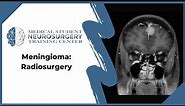 Meningioma: Radiosurgery