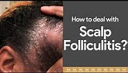 Dealing with Scalp Folliculitis? Watch immediately!