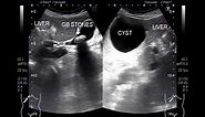 Ultrasound Video showing the Differentiation between Simple Hepatic Cyst and Hydatid Cyst.