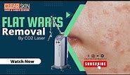 Amazing Ways To Get Rid Of Skin Warts Permanently || Co2 Laser Treatment for Flat Warts removal