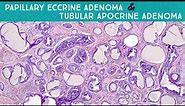 Papillary Eccrine Adenoma/Tubular Apocrine Adenoma: Dermpath in 5 Minutes