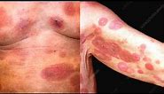 What is Mycosis Fungoides? Symptoms, Causes, Treatment, Diagnosis: Cutaneous T Cell Lymphoma