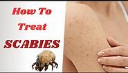 How To Treat Scabies Effectively | From PERMETHRIN Cream To IVERMECTIN Tablets