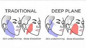 The Deep Plane Facelift is SO HOT right now. Why? | Marc Jacobs | FAQ