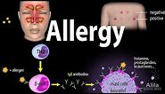 Allergy - Mechanism, Symptoms, Risk factors, Diagnosis, Treatment and Prevention, Animation
