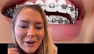Metal braces are the gold standard! #braces