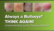 Think the Lyme Disease Rash is Always a Bull's-eye? Think Again! | Johns Hopkins Rheumatology