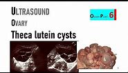 Theca lutein cysts or Hyperreaction luteinalis