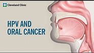 What Is HPV-Related Oral Cancer?