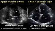 Echocardiography Normal Vs Abnormal Images | Heart Ultrasound | Cardiac Color/Spectral Doppler USG