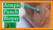 Armpit Sebaceous Cyst Punch Biopsy Removal | Auburn Medical Group