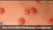 How to Get Rid of Molluscum Contagiosum