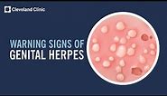 5 Warning Signs of Genital Herpes