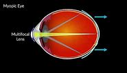 How Multifocal Contact Lenses Can Help Myopia